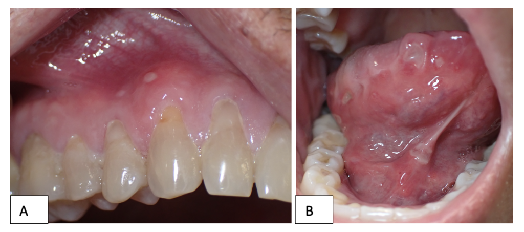 Pictures of teeth and tongue inside a mouth show ulcers.